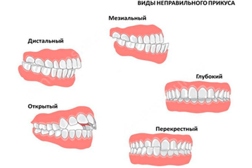 Виды неправильного прикуса зубов