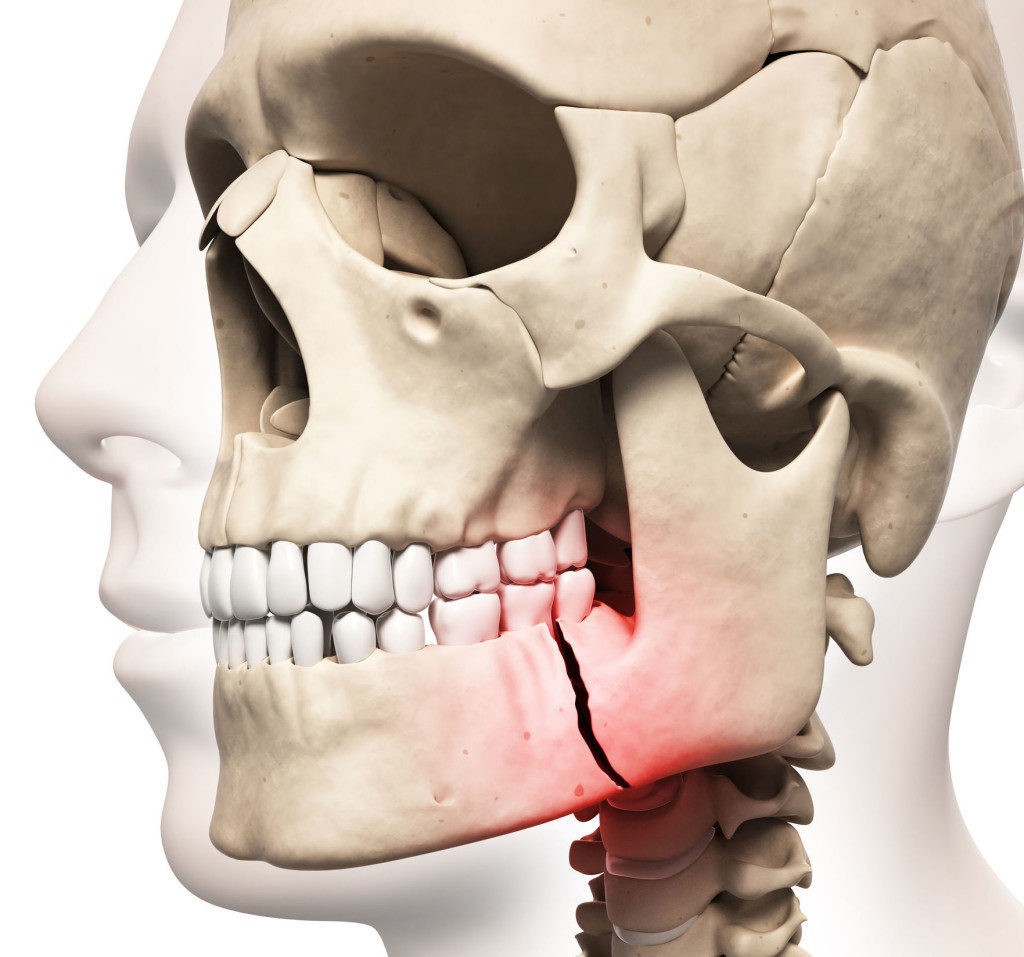 Остеосинтез челюсти лечение перелома верхней, нижней челюсти