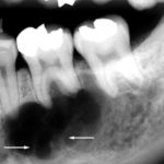 Рентген-периостита-нижней-челюсти
