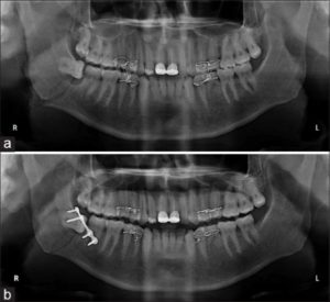 Остеосинтез челюсти до и после операции