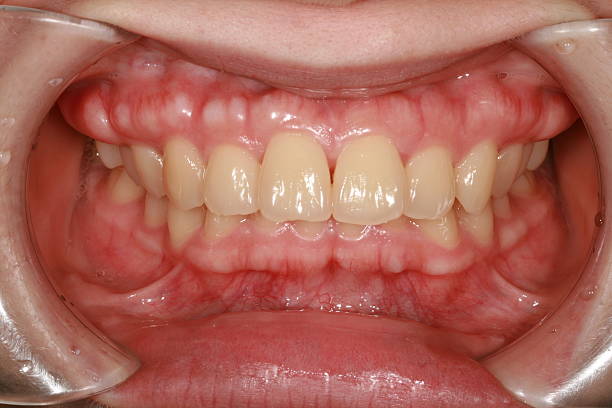 Экзостоз десны после удаления зуба: Что это и почему возникает