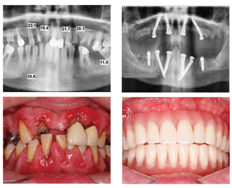 До и после протезирования зубов
