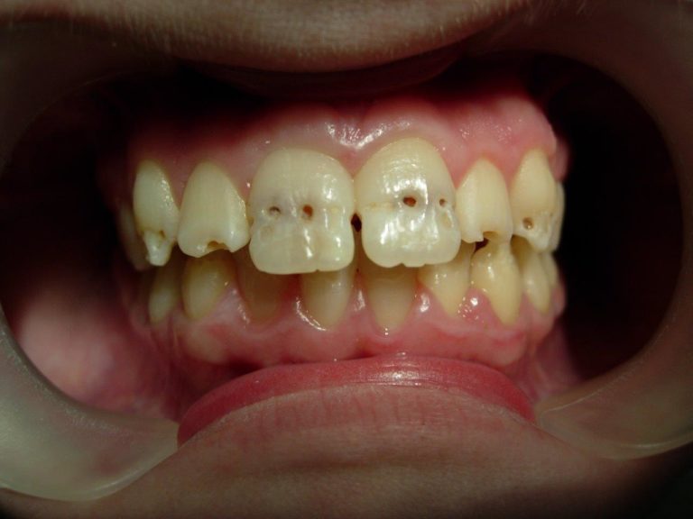 До лечения реставрации зубов