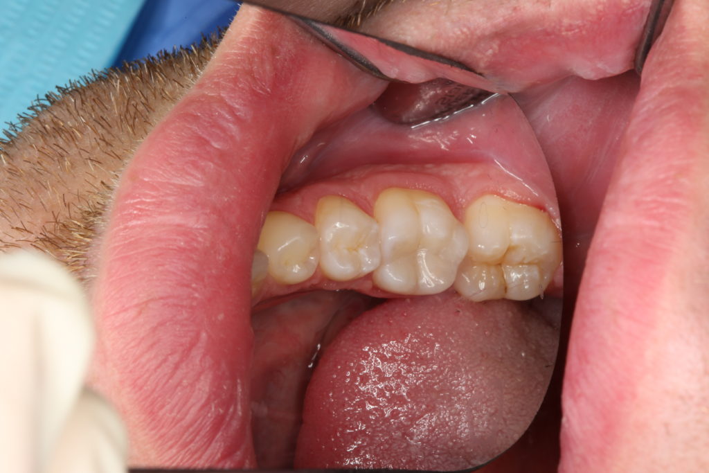 Пульпит зуба после лечения (случай 1)