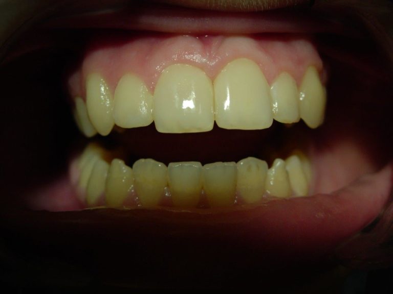После лечения реставрации зубов