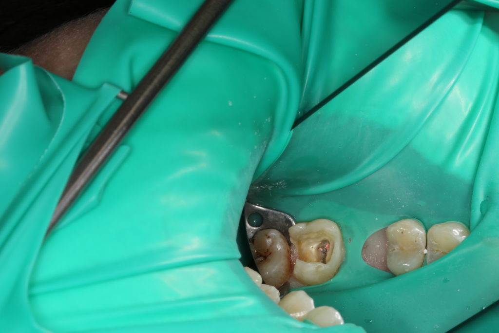 Пульпит зуба до лечения случай 2