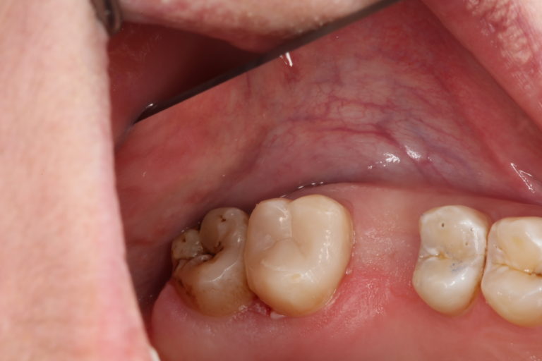 Пульпит зуба после лечения (случай 2)