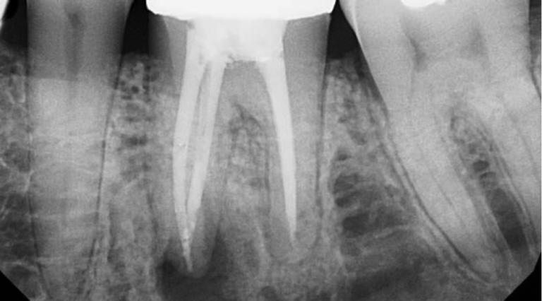 Апикальный периодонтит зуба лечение