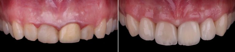 До и после операции удлинения зубов