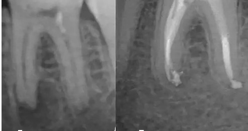 Киста до и после операции на зубе