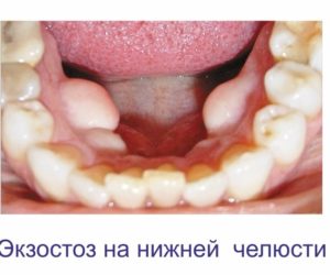 экзостоз нижней челюсти (2) (1)