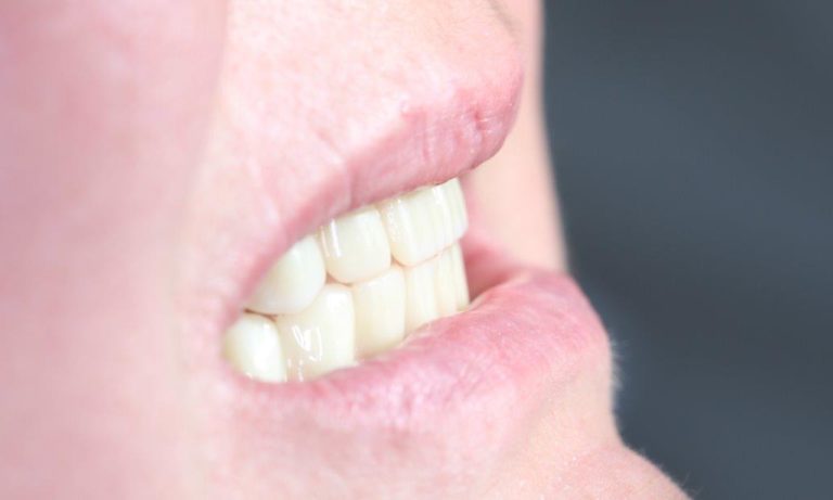 Протезирование зубов на 6 имплантатах
